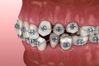 Anormal diş pozisyonu ve metal parantez tretament. Tıbbi olarak doğru diş 3d illüstrasyon