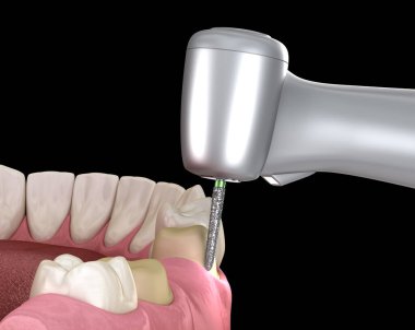 Diş taç yerleştirme için premolar hazırlık süreci. Tıbbi olarak doğru 3d illüstrasyon