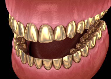 Altın dişler doğal dişler üzerinde taçlar. İnsan diş tedavisi tıbbi olarak doğru 3d illüstrasyon