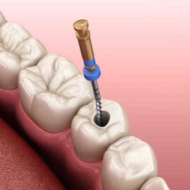 Endodontik kanal tedavisi. Tıbbi olarak doğru diş 3D illüstrasyon.