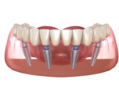 Alt çene protezi. Hepsi de implantlarla desteklenen 4 sistemde. İnsan dişleri ve protez kavramının tıbben doğru üç boyutlu çizimi