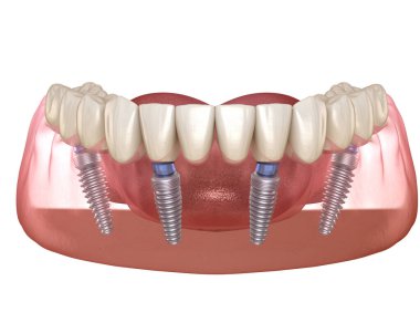 Mandibular prosthesis All on 4 system supported by implants. Medically accurate 3D illustration of human teeth and dentures concept clipart