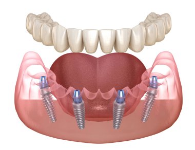 Alt çene protezi. Hepsi de implantlarla desteklenen 4 sistemde. İnsan dişleri ve protez kavramının tıbben doğru üç boyutlu çizimi