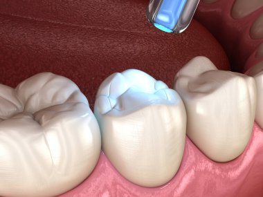 Doldurma ve polimerleştirme lambasıyla diş yenileme. Tıbbi olarak doğru diş 3D illüstrasyon.