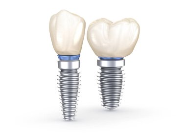 Diş implantları. İnsan dişlerinin 3 boyutlu illüstrasyon kavramı