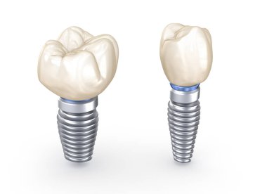 Diş implantları. İnsan dişlerinin 3 boyutlu illüstrasyon kavramı