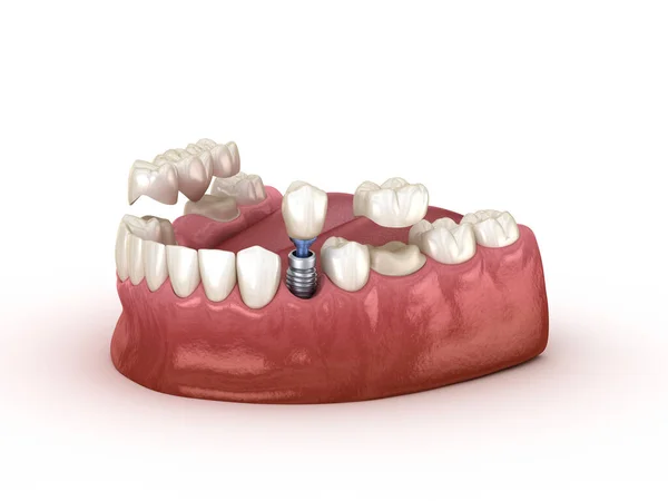 Tooth Recovery Implant Crown Medically Accurate Illustration Dental Concept — Stock Photo, Image