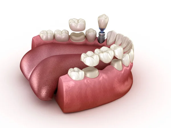 Zahnsanierung Mit Implantat Und Krone Medizinisch Korrekte Abbildung Zahnärztliches Konzept — Stockfoto