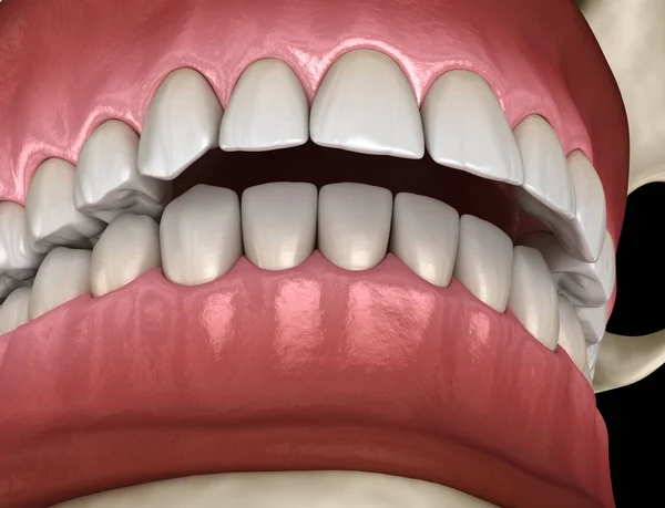 Overbite dental occlusion ( Malocclusion of teeth ). Medically accurate tooth 3D illustration