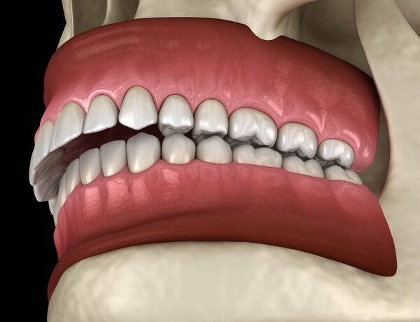 Overbite dental occlusion ( Malocclusion of teeth ). Medically accurate tooth 3D illustration