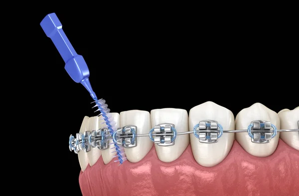 Cepillo Dental Interdental Limpieza Frenos Ilustración Médicamente Precisa Higiene Bucal —  Fotos de Stock