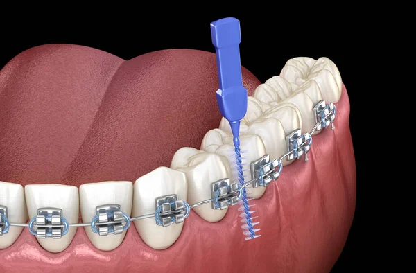 Prótesis Mandibular Todo Sistema Soportado Por Implantes Ilustración Médicamente Precisa —  Fotos de Stock