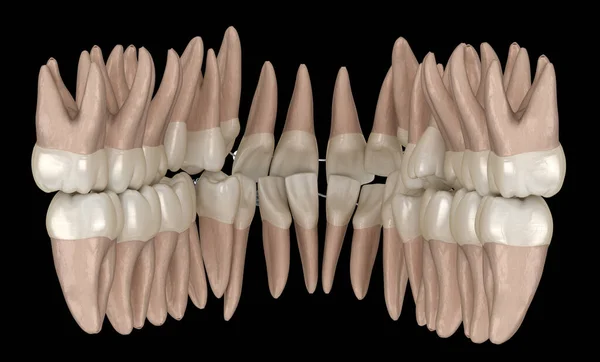 Posición Anormal Los Dientes Rodilleras Metálicas Tretament Ilustración Dental Médicamente — Foto de Stock