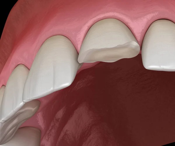 Σπασμένο Κεντρικό Δόντι Κοπτήρα Ιατρικά Ακριβής Τρισδιάστατη Απεικόνιση Των Ανθρώπινων — Φωτογραφία Αρχείου