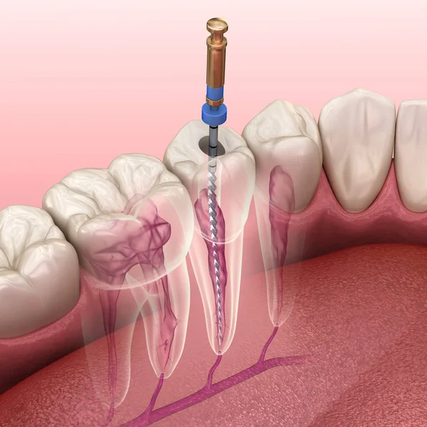 Endodontic root canal treatment process. Medically accurate tooth 3D illustration.