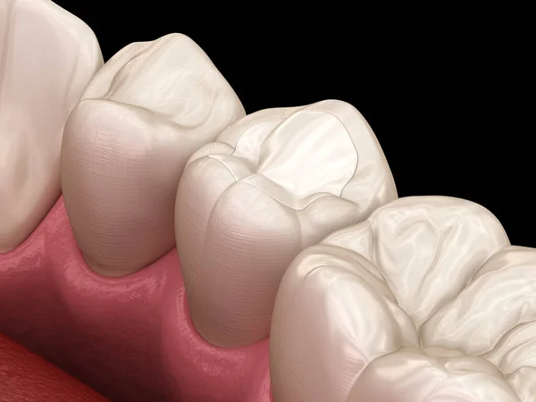 Restauração Dente Pré Molar Com Enchimento Ilustração Dente Medicamente Precisa — Fotografia de Stock