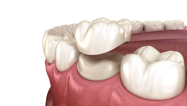 Diente Molar Preparado Para Colocación Corona Dental Ilustración Médicamente Precisa —  Fotos de Stock