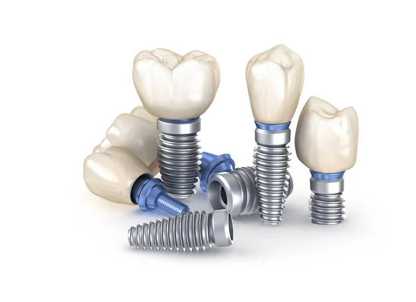 Implantes Dentários Ilustração Conceito Dentes Humanos — Fotografia de Stock