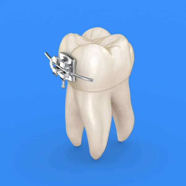 Tooth Metal Braces Illustration Concept — Stock Photo, Image