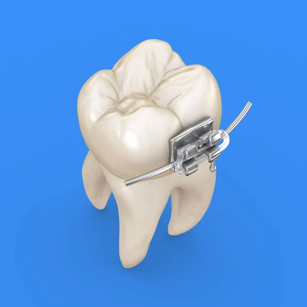 歯と金属のブレース 3Dイラストコンセプト — ストック写真