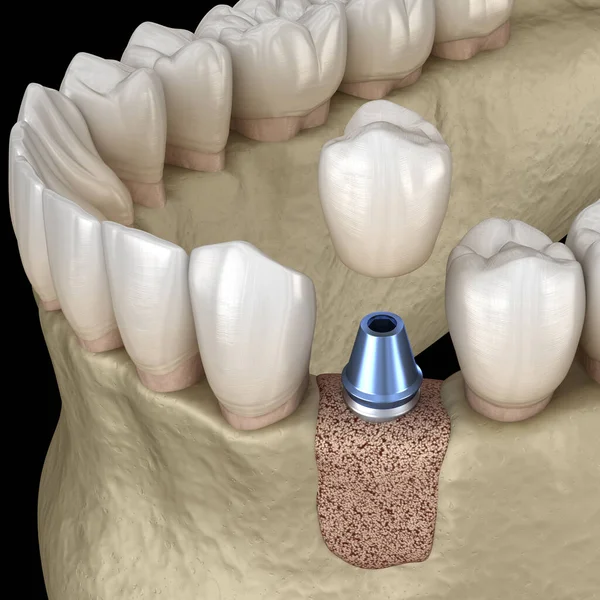 Augmentation Surgery Adding New Bone Illustration — Stock Photo, Image