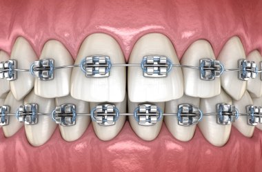 Metal parantez ile Sağlıklı Dişler. Tıbbi olarak doğru diş 3d illüstrasyon