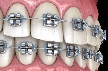 Metal parantez ile Sağlıklı Dişler. Tıbbi olarak doğru diş 3d illüstrasyon