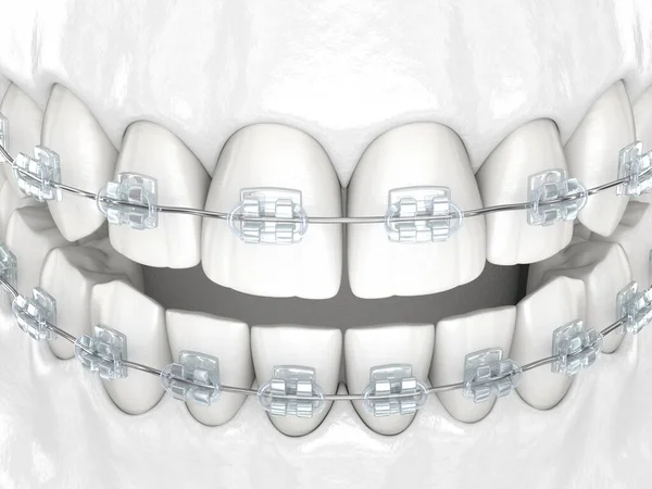 Teeth and Clear braces. Medically accurate dental 3D illustration