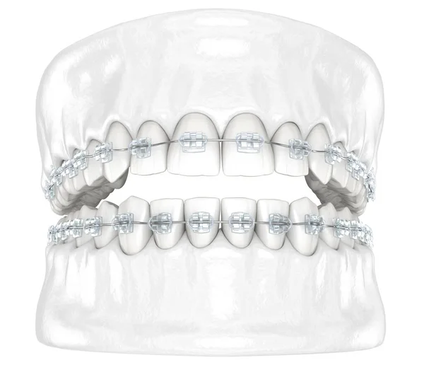 Teeth Clear Braces Medically Accurate Dental Illustration — Stock Photo, Image