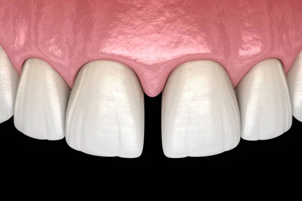 Diastema Dentes Incisivos Centrais Disfunção Dentária Ilustração Conceito — Fotografia de Stock