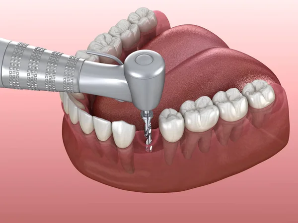 Diş Implantı Yerleştirilirken Kemiğin Delinmesi Nsan Dişleri Protez Kavramının Tıbben — Stok fotoğraf