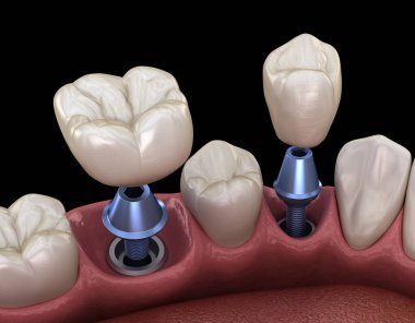 Premolar ve Molar diş taç implant üzerine kurulum - kavram. İnsan dişleri ve protezleri 3d illüstrasyon