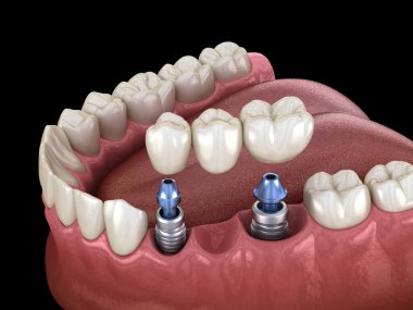 Diş köprüsü implantlarla destekleniyor. İnsan dişleri ve protez kavramının tıbben doğru üç boyutlu çizimi