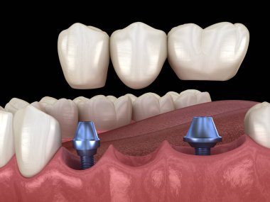 Diş köprüsü implantlarla destekleniyor. İnsan dişleri ve protez kavramının tıbben doğru üç boyutlu çizimi