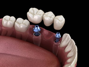 Diş köprüsü implantlarla destekleniyor. İnsan dişleri ve protez kavramının tıbben doğru üç boyutlu çizimi