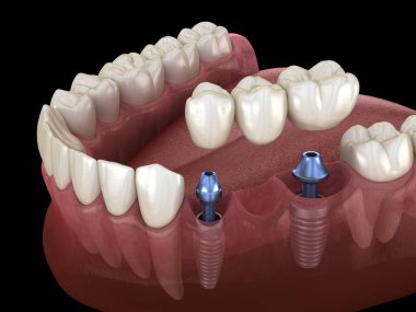 Diş köprüsü implantlarla destekleniyor. İnsan dişleri ve protez kavramının tıbben doğru üç boyutlu çizimi