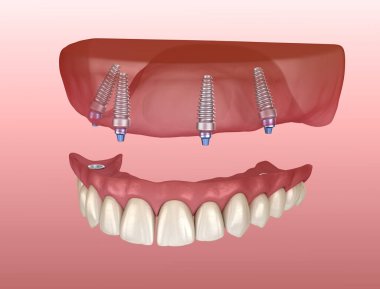 Çikletli Maxillary protezi. Hepsi de implantlarla desteklenen 4 sistemde. İnsan dişlerinin ve protezlerinin tıbbi açıdan doğru üç boyutlu çizimi