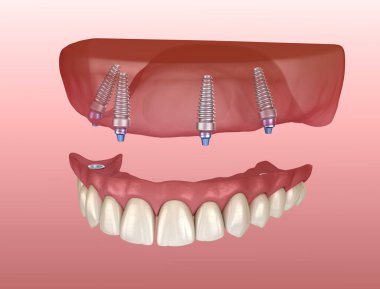 Maxillary prosthesis with gum All on 4 system supported by implants. Medically accurate 3D illustration of human teeth and dentures clipart
