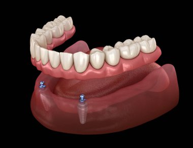 Alt çene çıkarılabilir protez. Hepsi top eklentili implantlar tarafından desteklenen 2 sistemde. Tıbbi olarak doğru olan 3 boyutlu diş illüstrasyonu