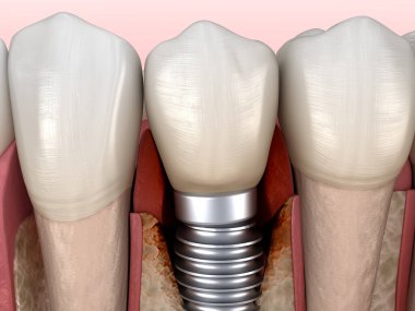 Görülebilir kemik hasarlı perisiplantit. Diş implantı kavramının tıbben doğru üç boyutlu çizimi