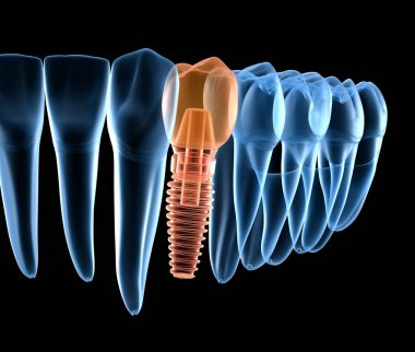 İmplant ile premolar diş kurtarma, x-Ray görünümü. İnsan dişleri ve protezkavramının tıbbi olarak doğru 3d illüstrasyon