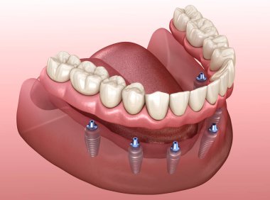 Çikletli çene protezi. Hepsi de implantlarla desteklenen 6 sistemde. İnsan dişleri ve protez kavramının tıbben doğru üç boyutlu çizimi