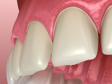 Merkezi kesici diş ve yanal kesici diş üzerinde Venedik kurulum prosedürü için diş hazırlığı. Tıbbi olarak doğru diş 3D illüstrasyon