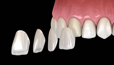 Merkezi kesici diş ve yan kesici diş üzerinde vener kurulum prosedürü. Tıbbi olarak doğru diş 3D illüstrasyon
