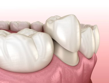 Diş taç yerleştirme için önceden paralanmış premolar diş. Tıbbi olarak doğru 3d illüstrasyon