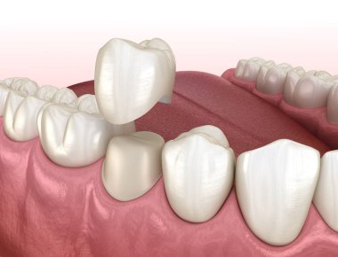 Diş taç yerleştirme için önceden paralanmış premolar diş. Tıbbi olarak doğru 3d illüstrasyon