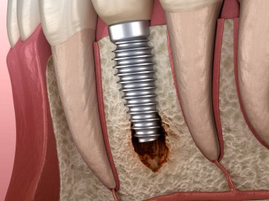 Görülebilir kemik hasarlı perisiplantit. Diş implantı kavramının tıbben doğru üç boyutlu çizimi