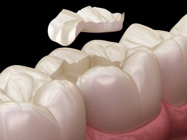 Inlay ceramic crown fixation over tooth. Medically accurate 3D illustration of human teeth treatment clipart