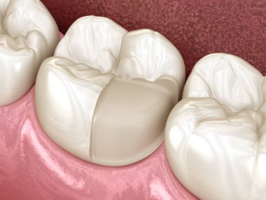 Onlay seramik diş üzerindeki taç takıntısı için hazırlık. İnsan diş tedavisinin tıbbi açıdan doğru üç boyutlu çizimi