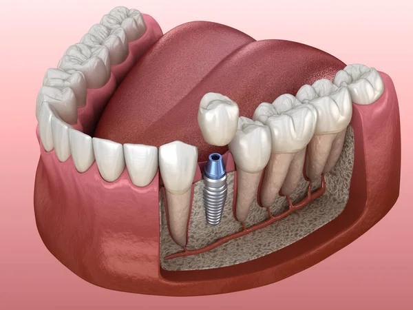 Installation Couronne Dentaire Prémolaire Sur Culée Implant Illustration Médicalement Précise — Photo